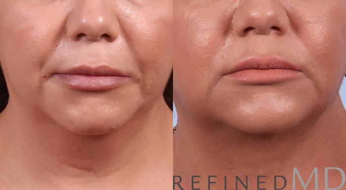 Before & After Necklift Case 1085 View 1 View in Los Gatos & San Jose, CA