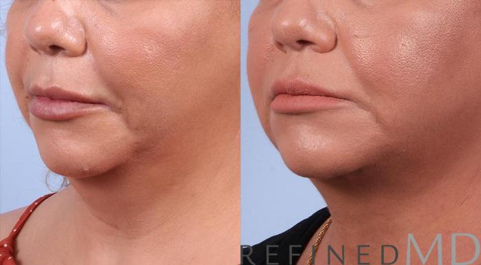 Before & After Necklift Case 1085 View 2 View in Los Gatos & San Jose, CA