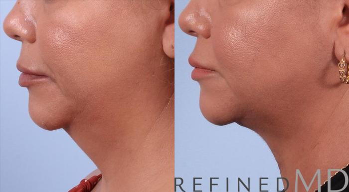 Before & After Necklift Case 1085 View 3 View in Los Gatos & San Jose, CA