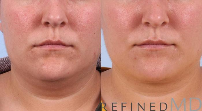 Before & After Necklift Case 1086 View 1 View in Los Gatos & San Jose, CA
