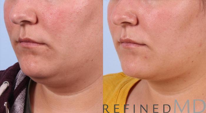 Before & After Necklift Case 1086 View 2 View in Los Gatos & San Jose, CA