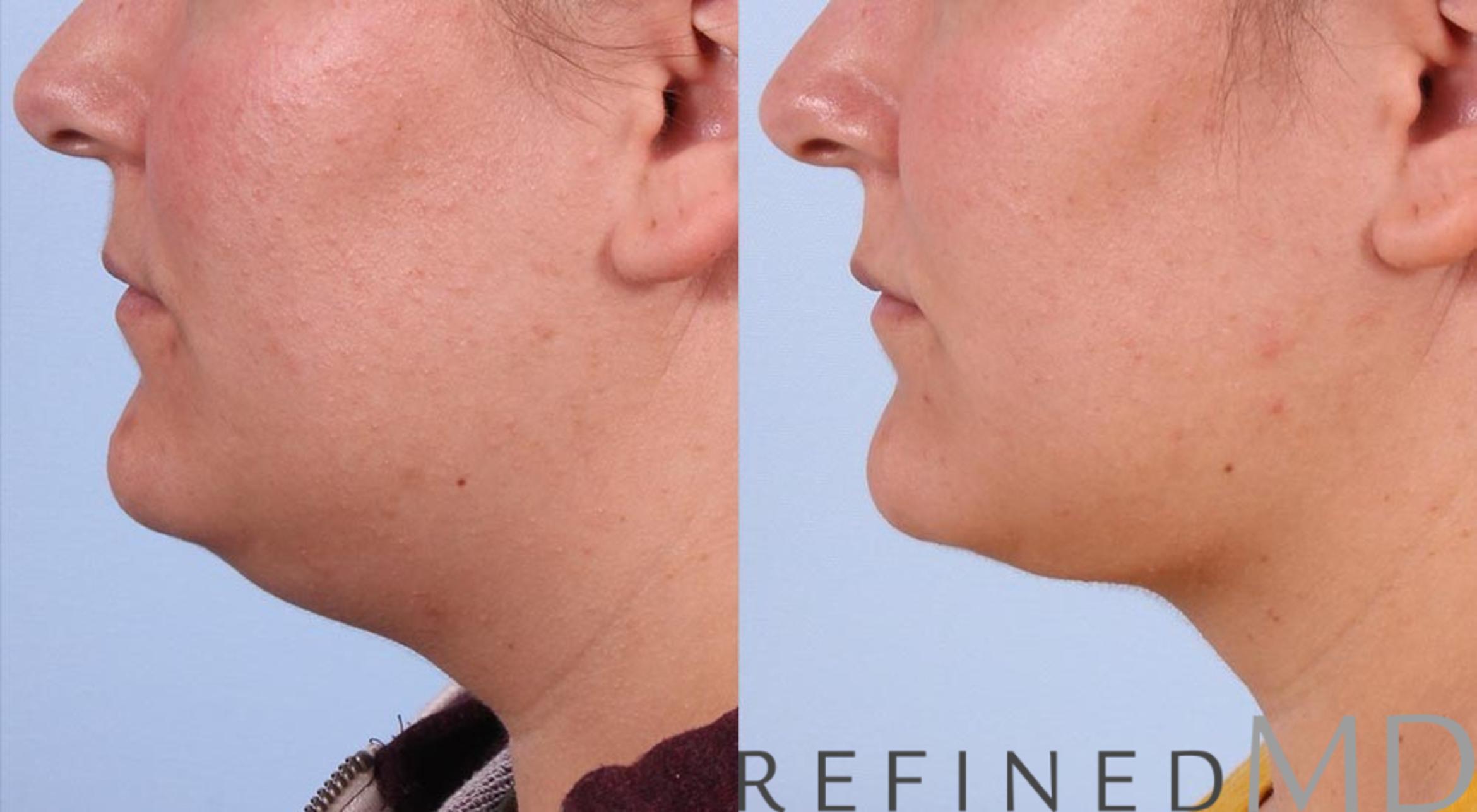 Before & After Necklift Case 1086 View 3 View in Los Gatos & San Jose, CA