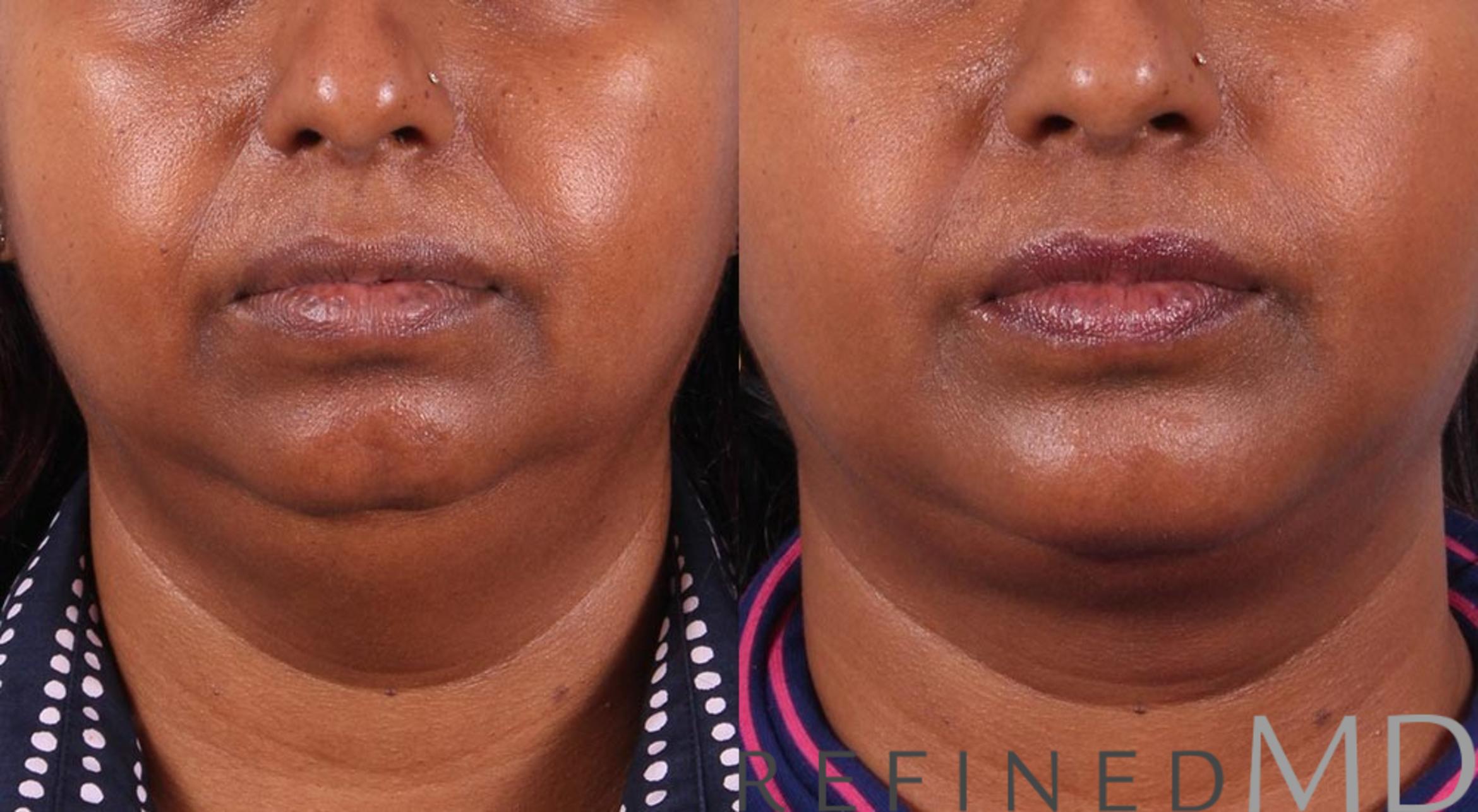 Before & After Necklift Case 1087 View 1 View in Los Gatos & San Jose, CA
