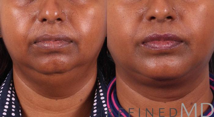 Before & After Necklift Case 1087 View 1 View in Los Gatos & San Jose, CA