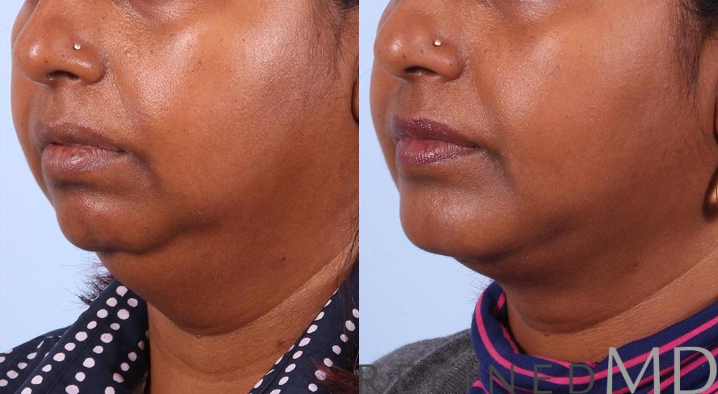 Before & After Necklift Case 1087 View 2 View in Los Gatos & San Jose, CA