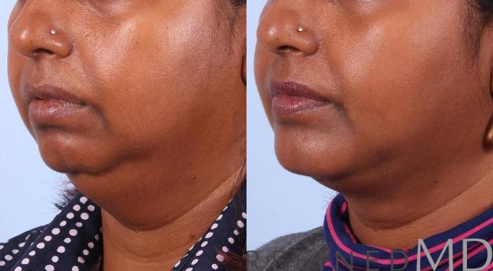 Before & After Necklift Case 1087 View 2 View in Los Gatos & San Jose, CA