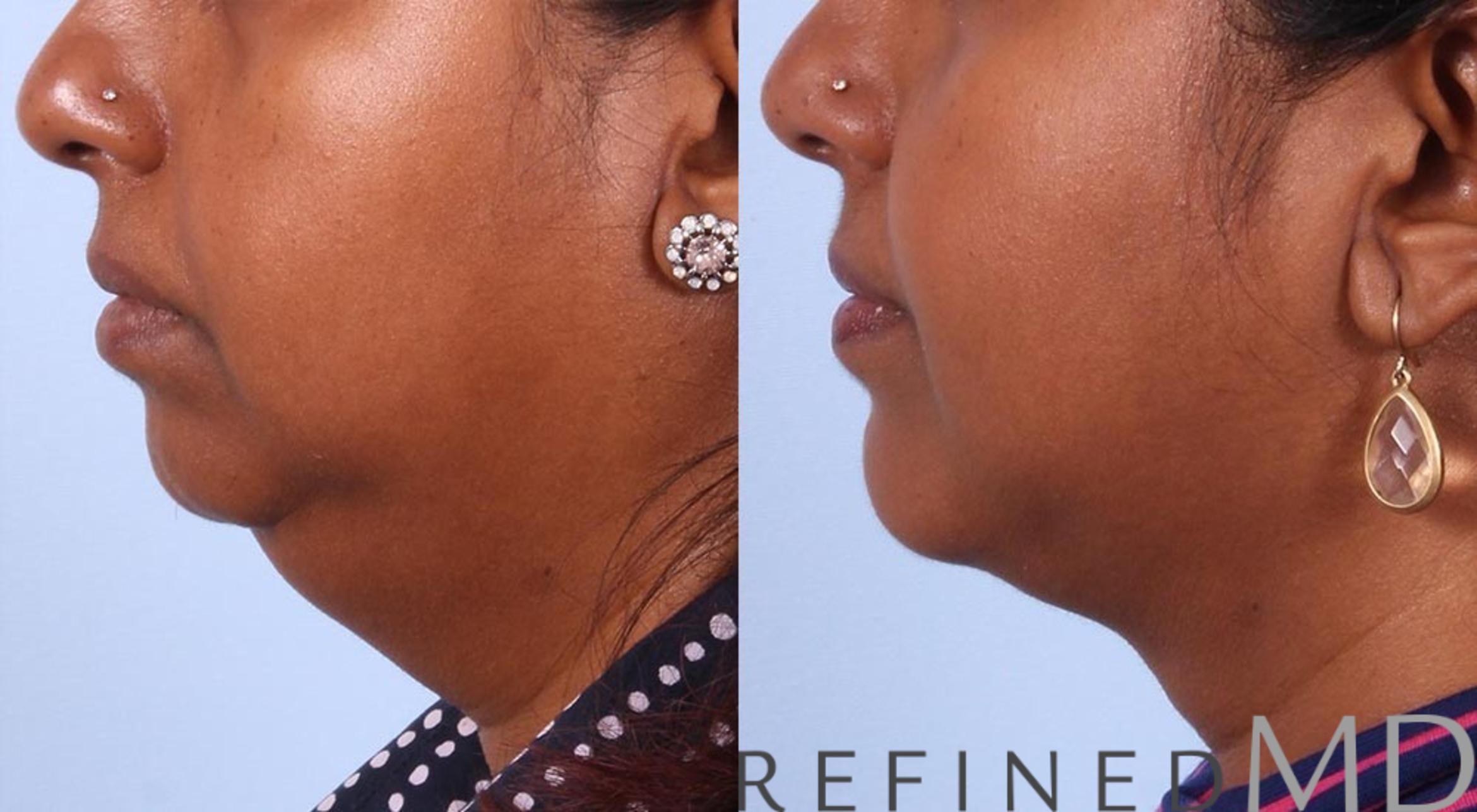 Before & After Necklift Case 1087 View 3 View in Los Gatos & San Jose, CA