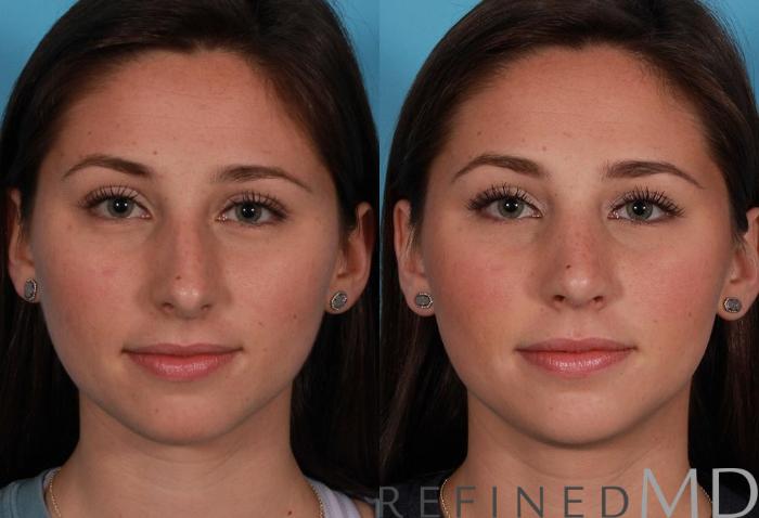 Before & After Rhinoplasty Case 1120 View 1 View in Los Gatos & San Jose, CA
