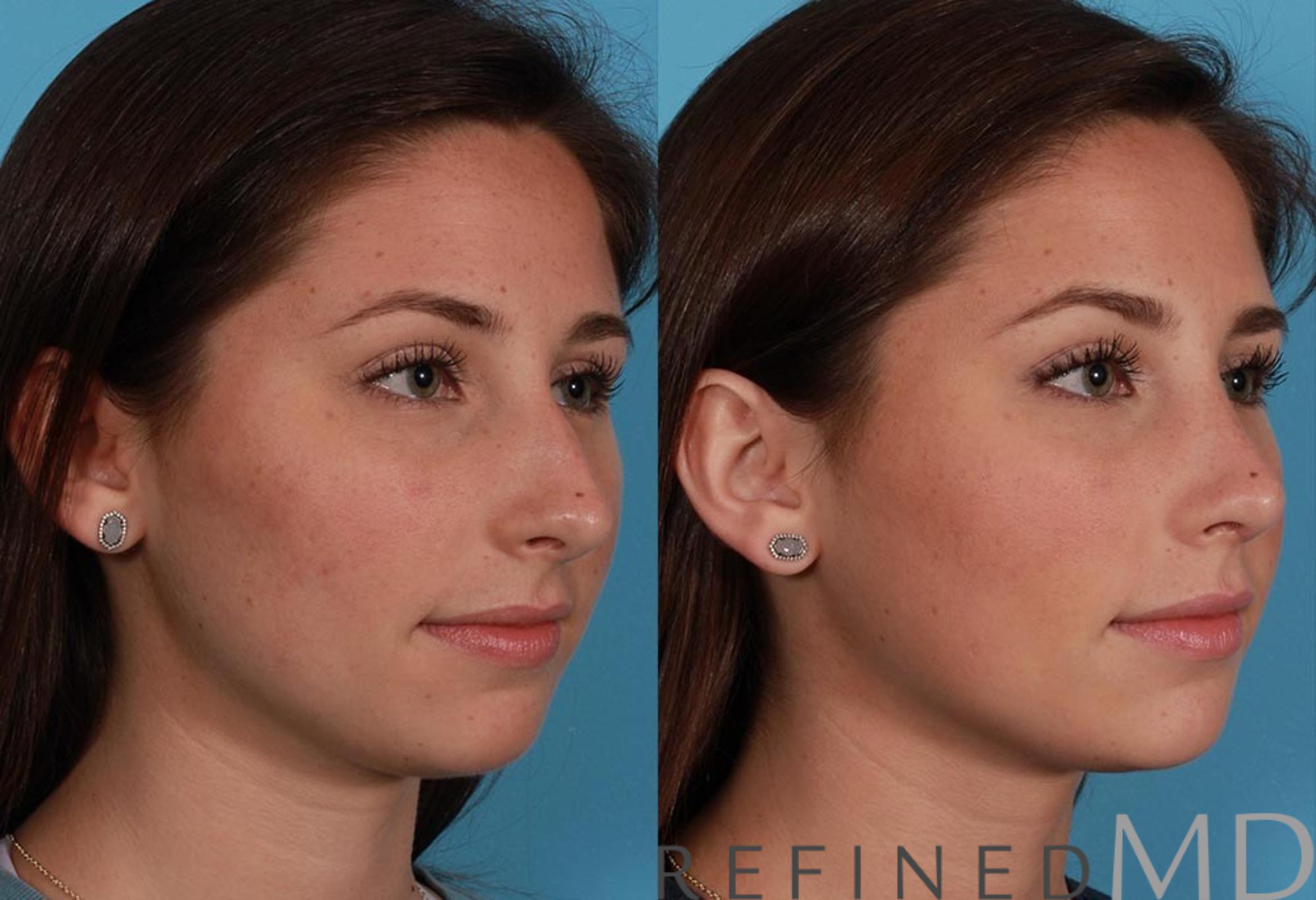 Before & After Rhinoplasty Case 1120 View 2 View in Los Gatos & San Jose, CA