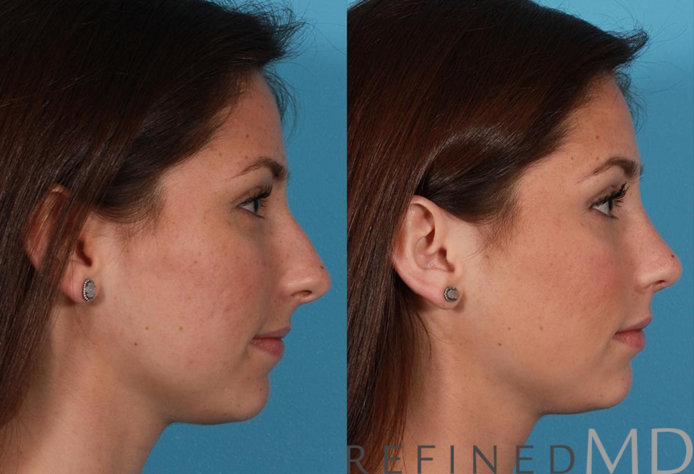Before & After Rhinoplasty Case 1120 View 3 View in Los Gatos & San Jose, CA
