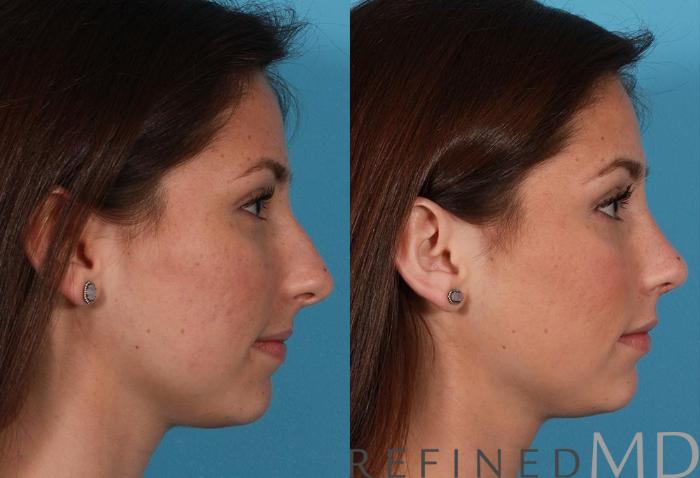 Before & After Rhinoplasty Case 1120 View 3 View in Los Gatos & San Jose, CA