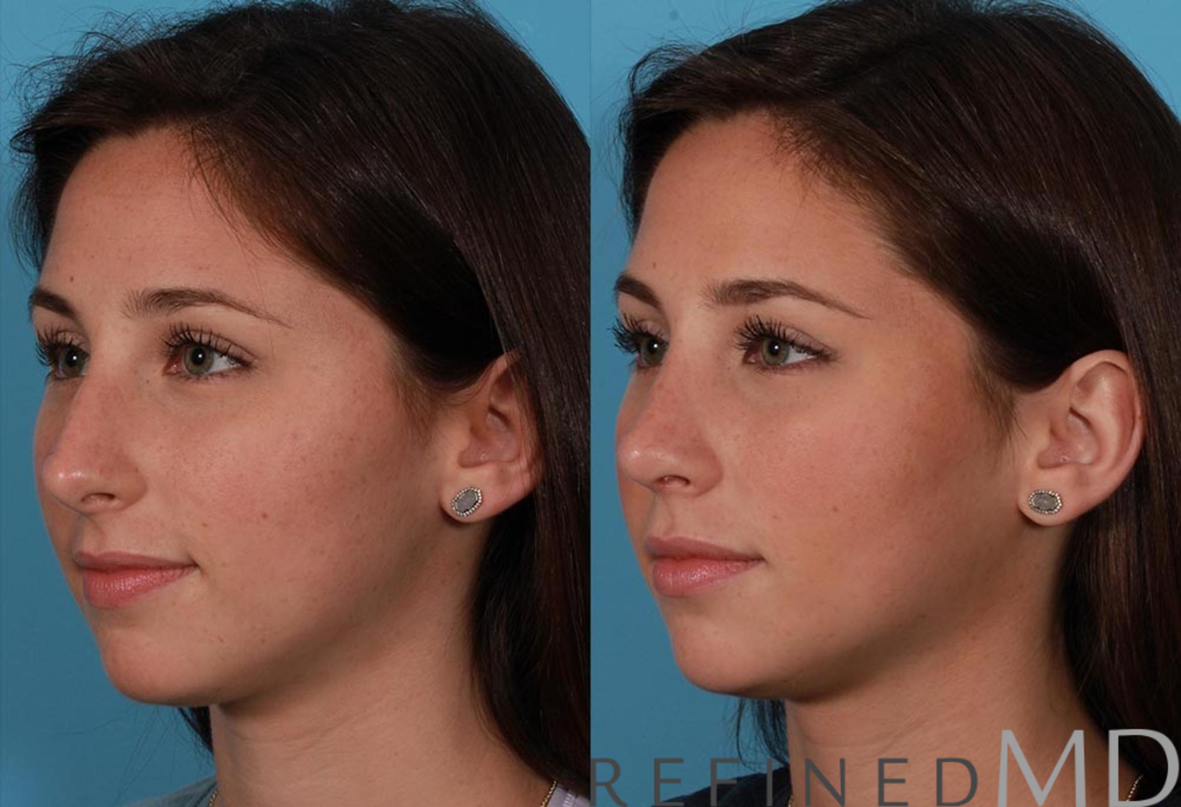Before & After Rhinoplasty Case 1120 View 4 View in Los Gatos & San Jose, CA