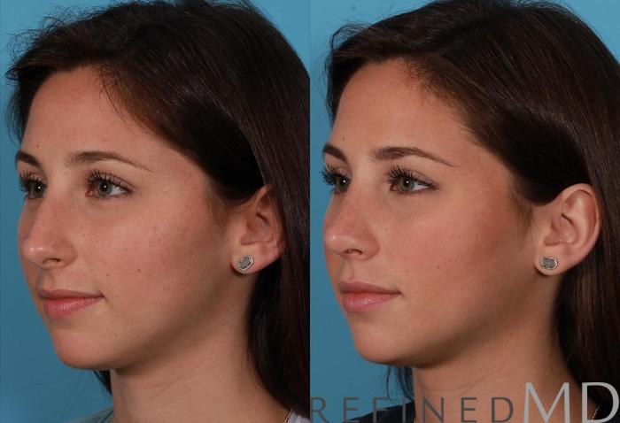 Before & After Rhinoplasty Case 1120 View 4 View in Los Gatos & San Jose, CA