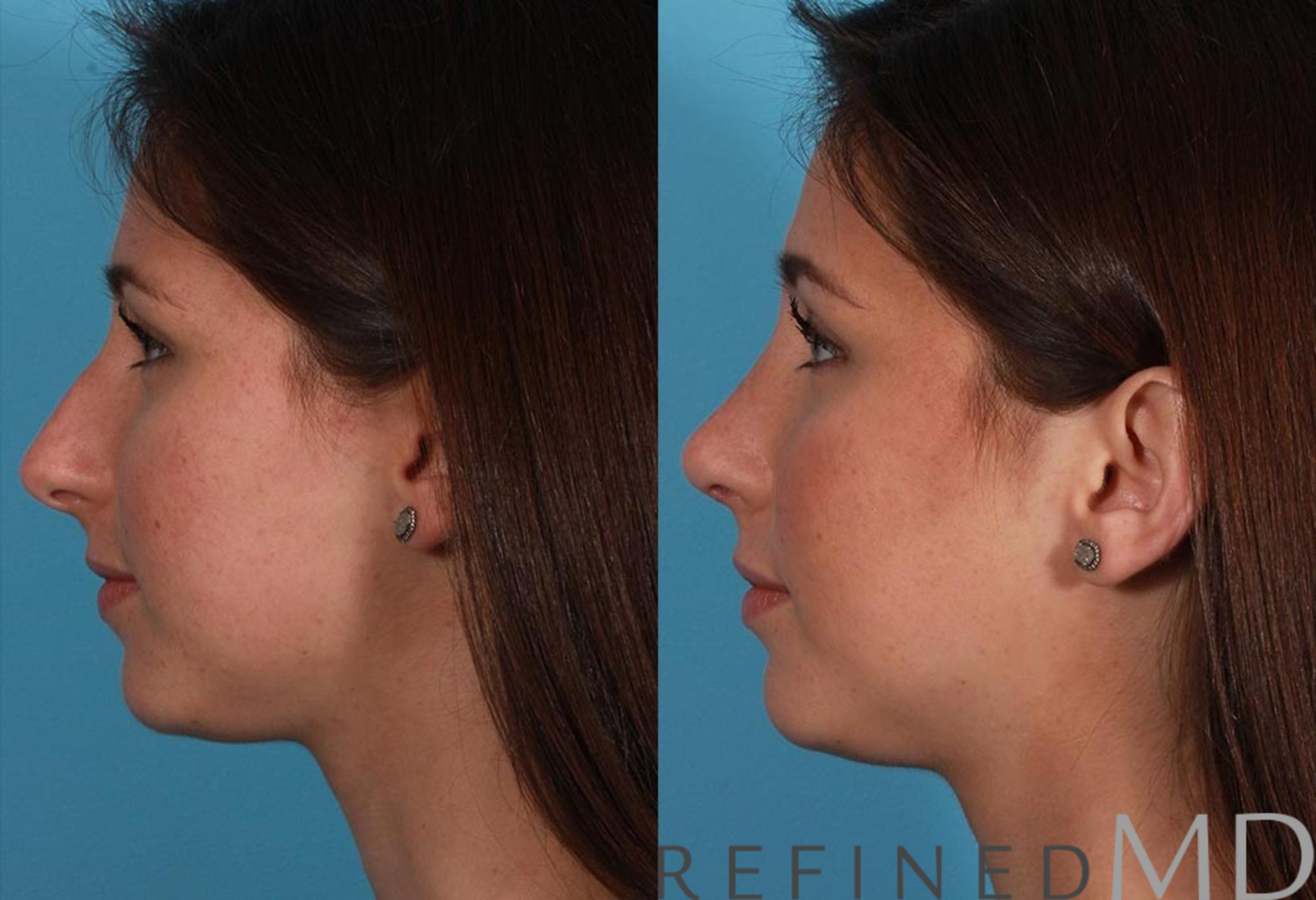 Before & After Rhinoplasty Case 1120 View 5 View in Los Gatos & San Jose, CA