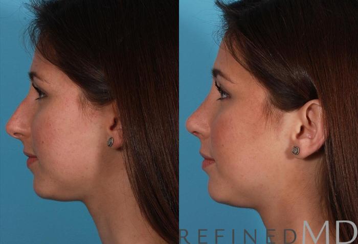 Before & After Rhinoplasty Case 1120 View 5 View in Los Gatos & San Jose, CA