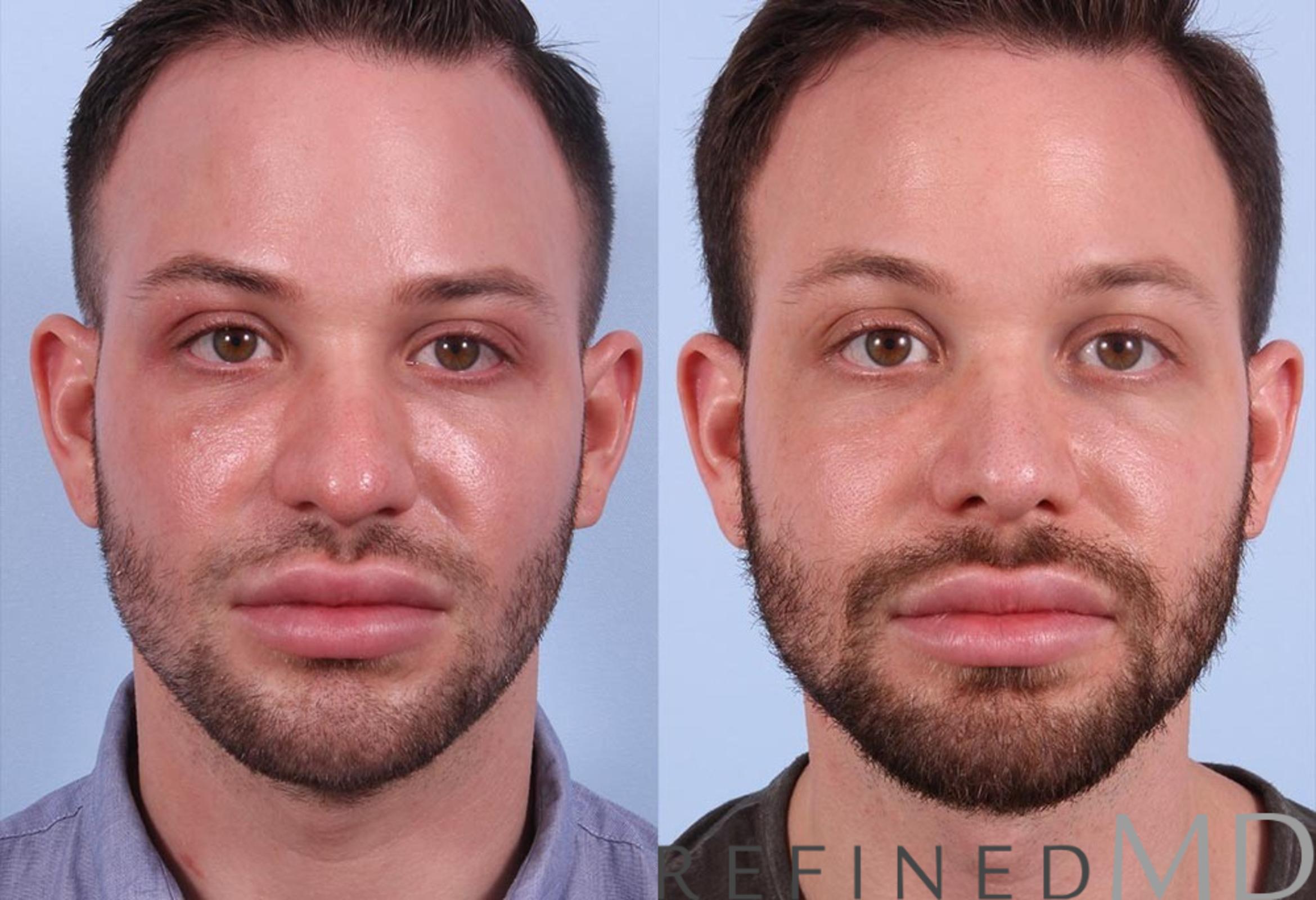 Before & After Rhinoplasty Case 1121 View 1 View in Los Gatos & San Jose, CA