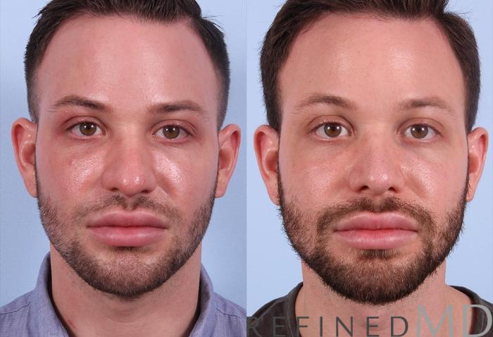 Before & After Rhinoplasty Case 1121 View 1 View in Los Gatos & San Jose, CA