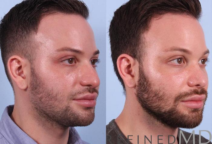Before & After Rhinoplasty Case 1121 View 2 View in Los Gatos & San Jose, CA