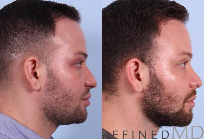 Before & After Rhinoplasty Case 1121 View 3 View in Los Gatos & San Jose, CA