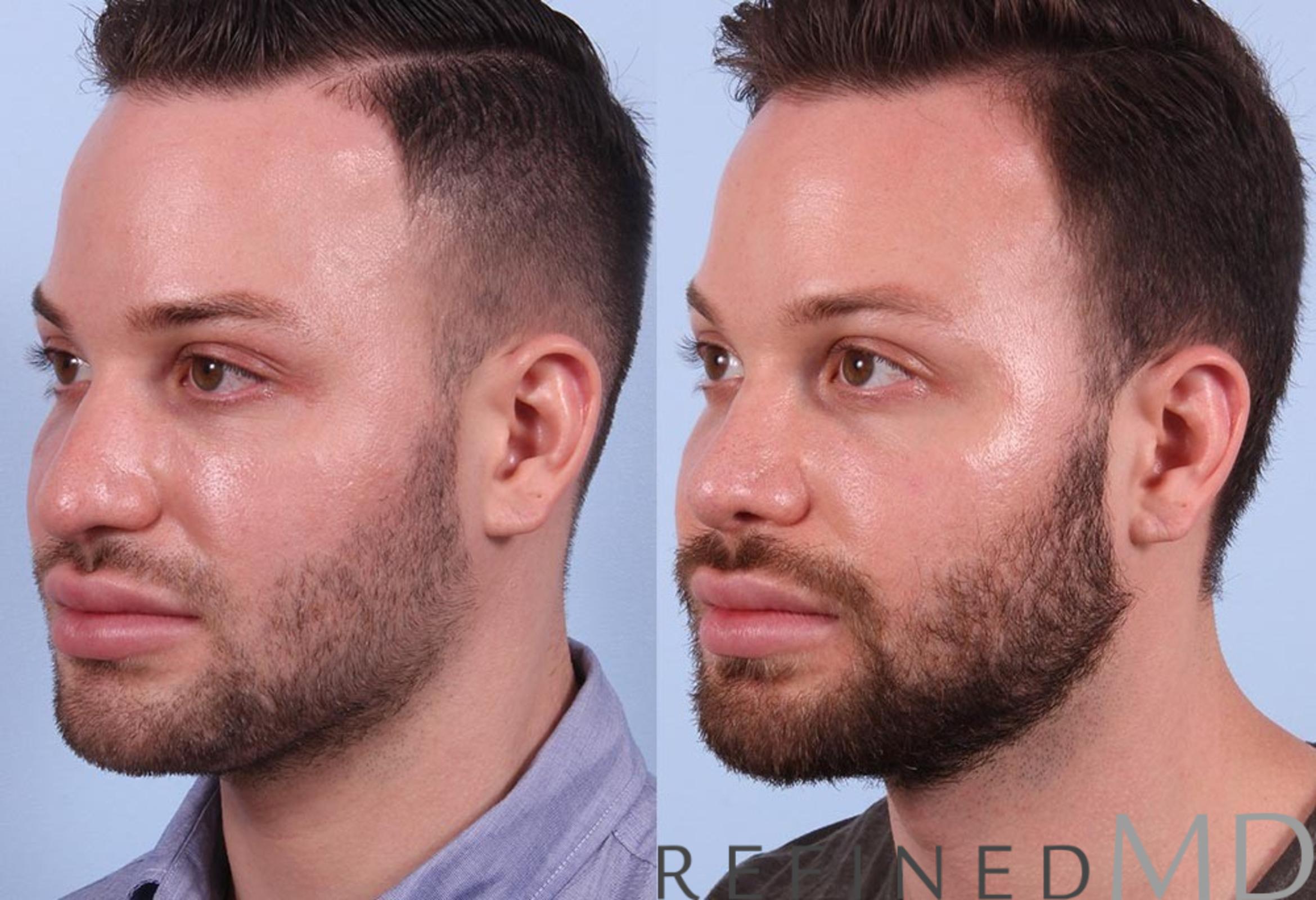 Before & After Rhinoplasty Case 1121 View 4 View in Los Gatos & San Jose, CA
