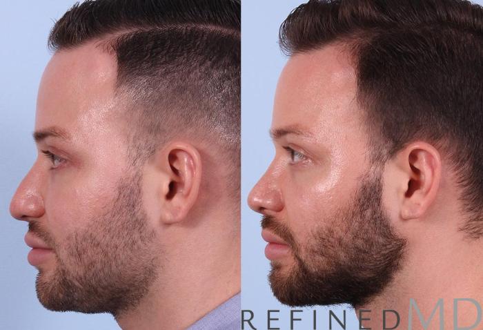 Before & After Rhinoplasty Case 1121 View 5 View in Los Gatos & San Jose, CA