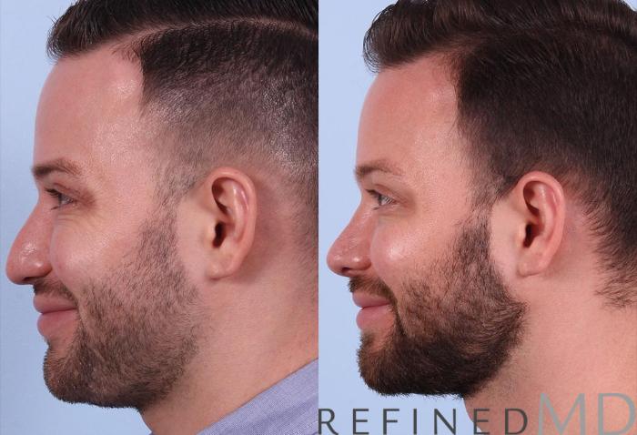 Before & After Rhinoplasty Case 1121 View 6 View in Los Gatos & San Jose, CA