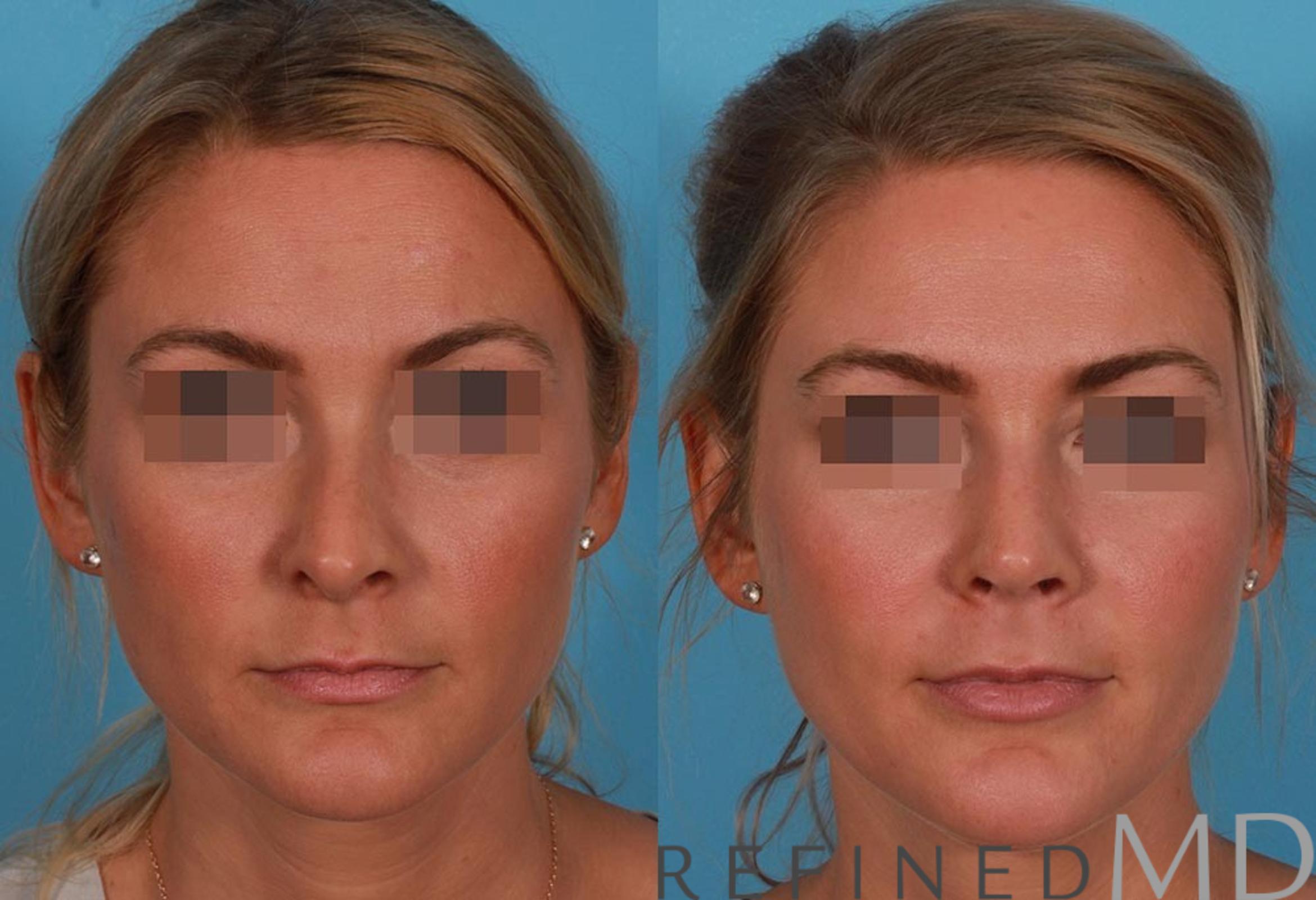 Before & After Rhinoplasty Case 1122 View 1 View in Los Gatos & San Jose, CA