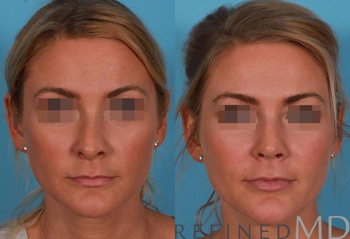 Before & After Rhinoplasty Case 1122 View 1 View in Los Gatos & San Jose, CA