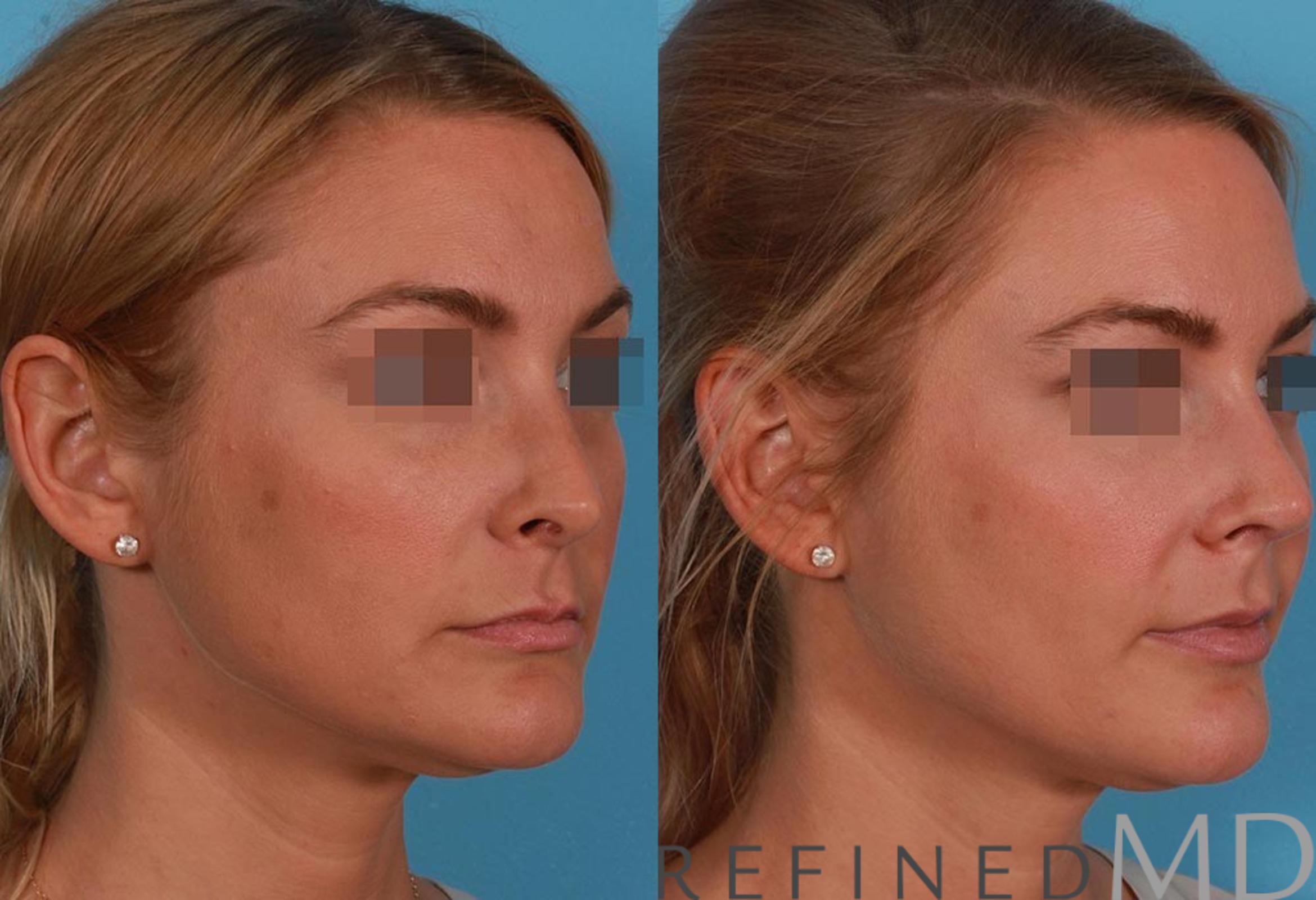 Before & After Rhinoplasty Case 1122 View 2 View in Los Gatos & San Jose, CA