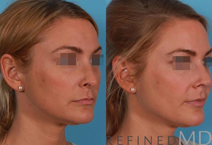 Before & After Rhinoplasty Case 1122 View 2 View in Los Gatos & San Jose, CA