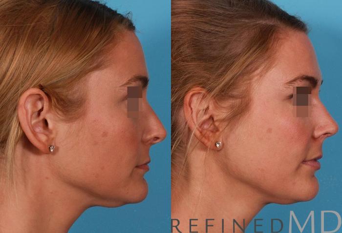 Before & After Rhinoplasty Case 1122 View 3 View in Los Gatos & San Jose, CA