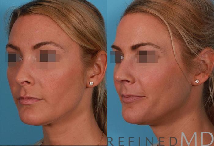 Before & After Rhinoplasty Case 1122 View 4 View in Los Gatos & San Jose, CA
