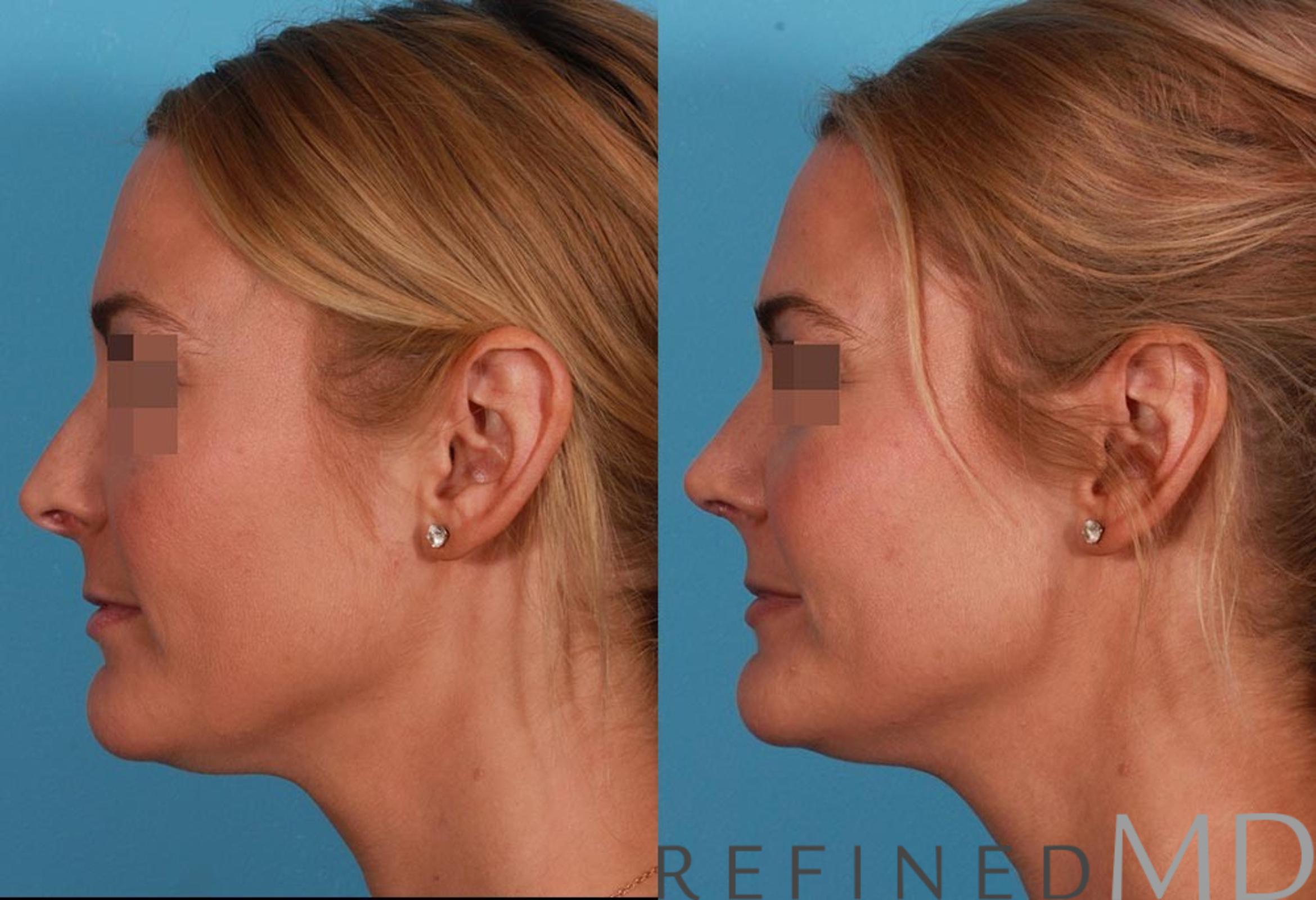 Before & After Rhinoplasty Case 1122 View 5 View in Los Gatos & San Jose, CA