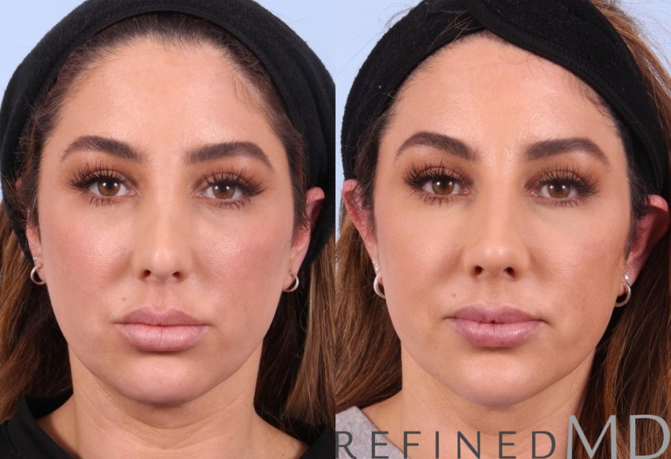 Before & After Rhinoplasty Case 1123 View 1 View in Los Gatos & San Jose, CA