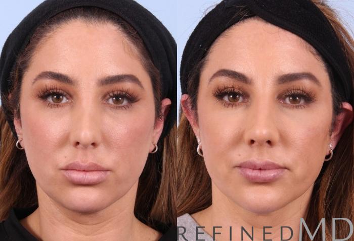 Before & After Rhinoplasty Case 1123 View 1 View in Los Gatos & San Jose, CA