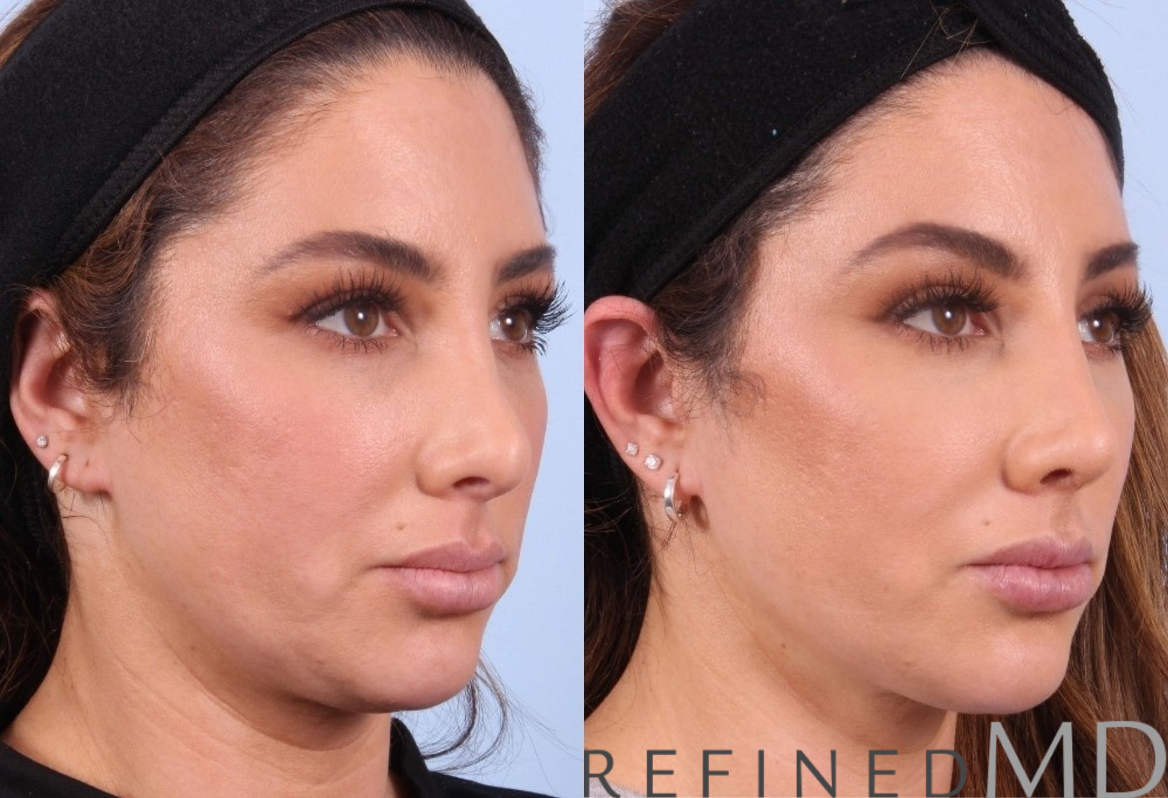 Before & After Rhinoplasty Case 1123 View 2 View in Los Gatos & San Jose, CA