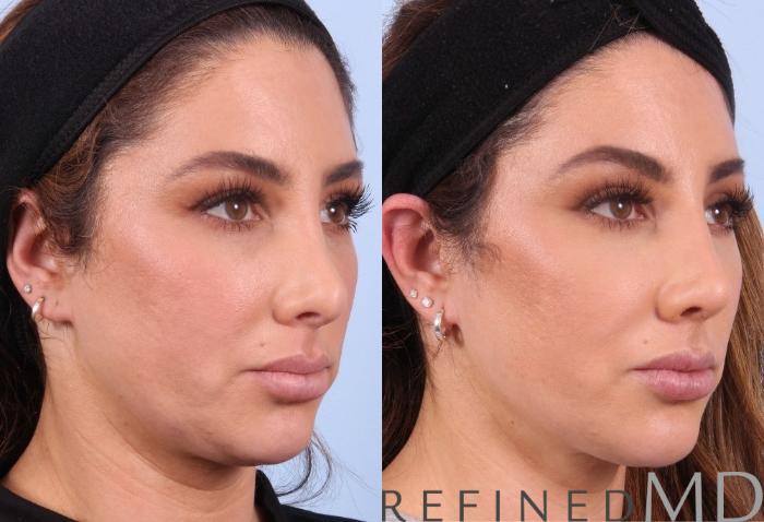 Before & After Rhinoplasty Case 1123 View 2 View in Los Gatos & San Jose, CA