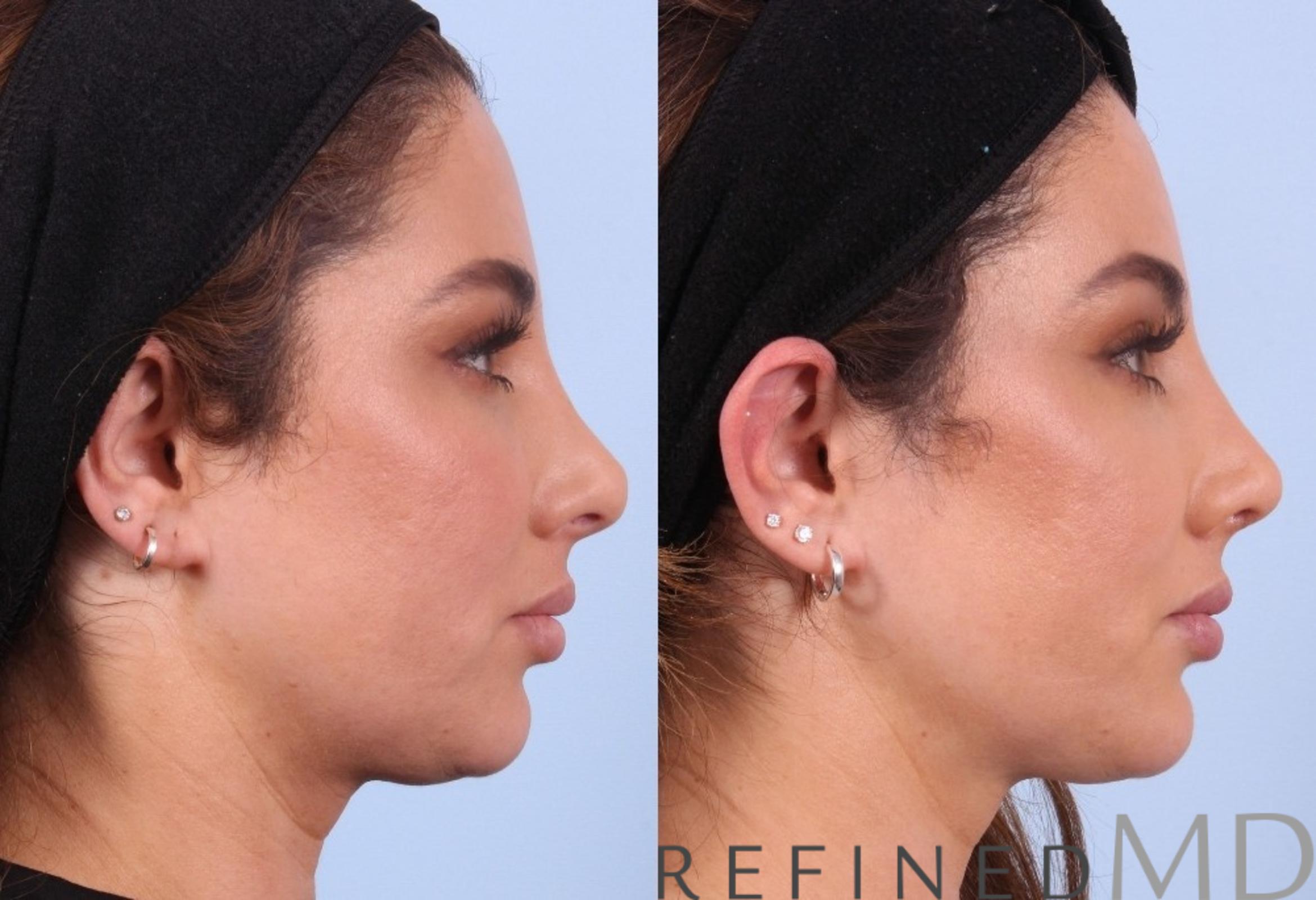 Before & After Rhinoplasty Case 1123 View 3 View in Los Gatos & San Jose, CA