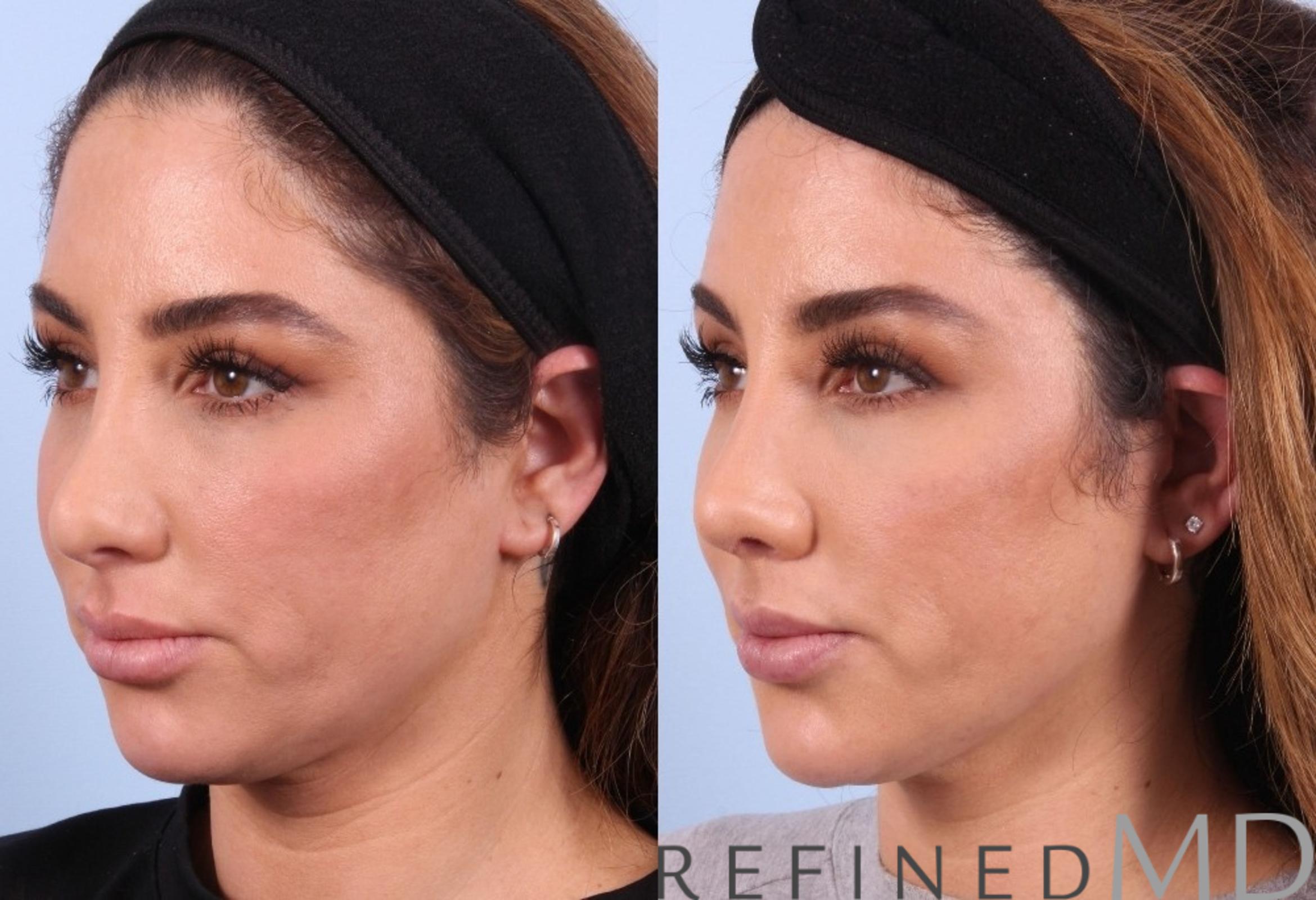 Before & After Rhinoplasty Case 1123 View 4 View in Los Gatos & San Jose, CA