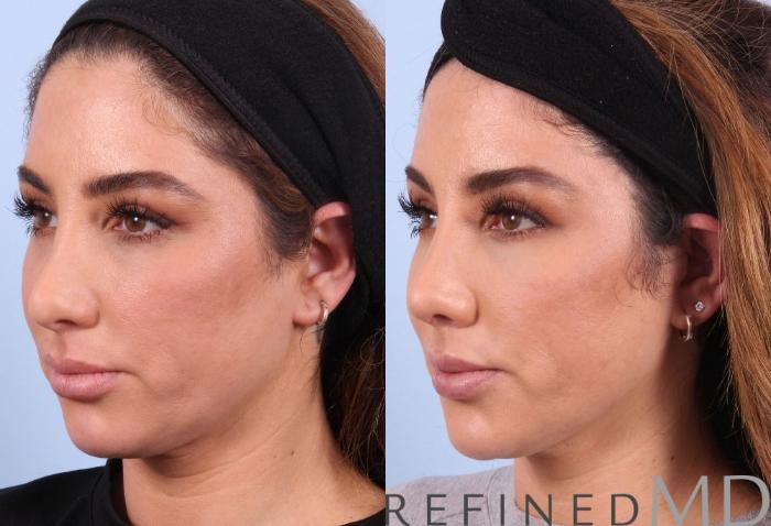 Before & After Rhinoplasty Case 1123 View 4 View in Los Gatos & San Jose, CA