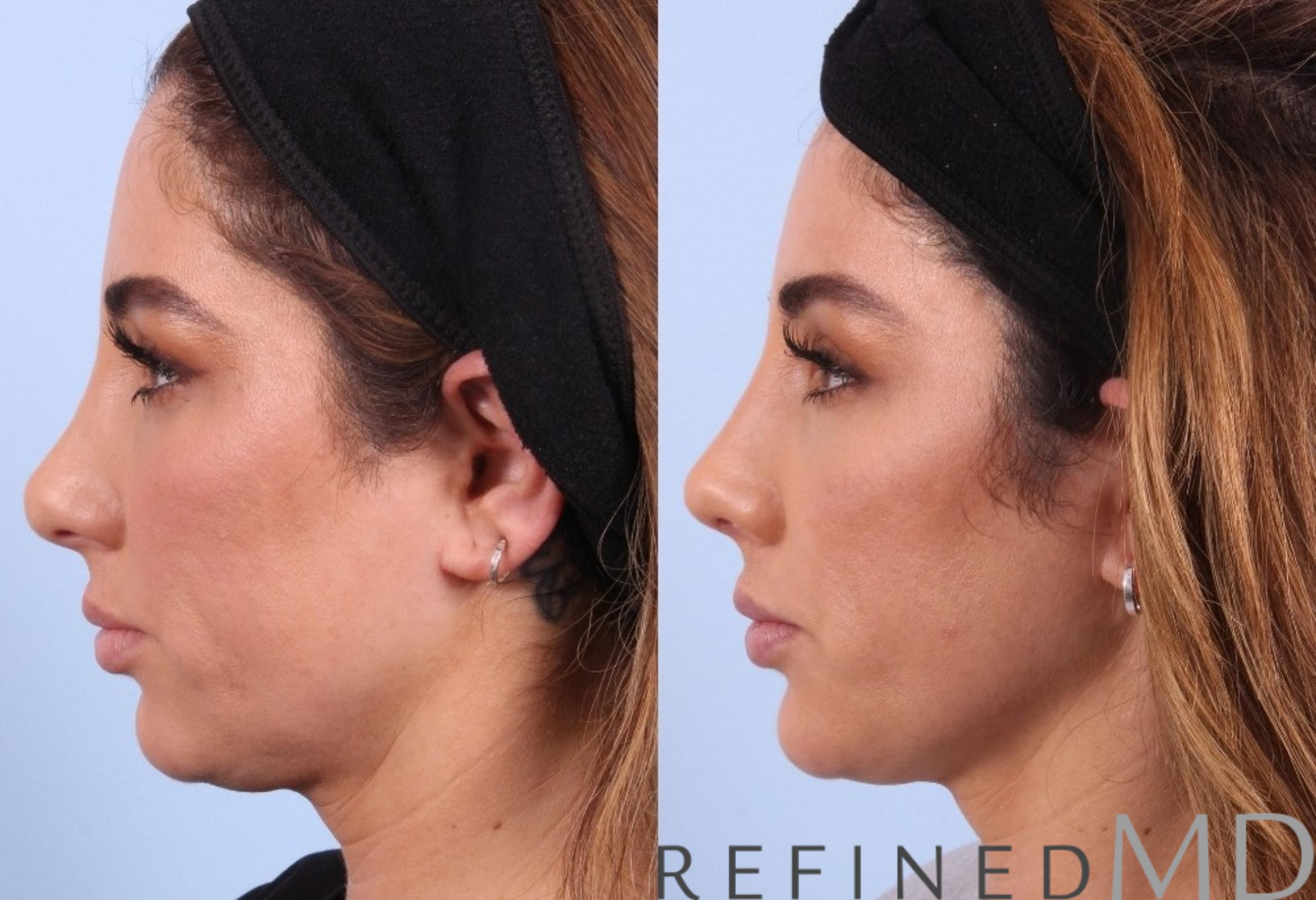Before & After Rhinoplasty Case 1123 View 5 View in Los Gatos & San Jose, CA
