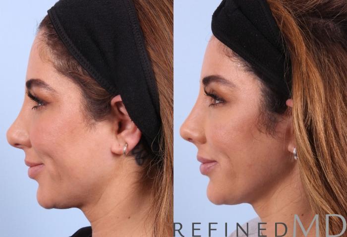 Before & After Rhinoplasty Case 1123 View 6 View in Los Gatos & San Jose, CA