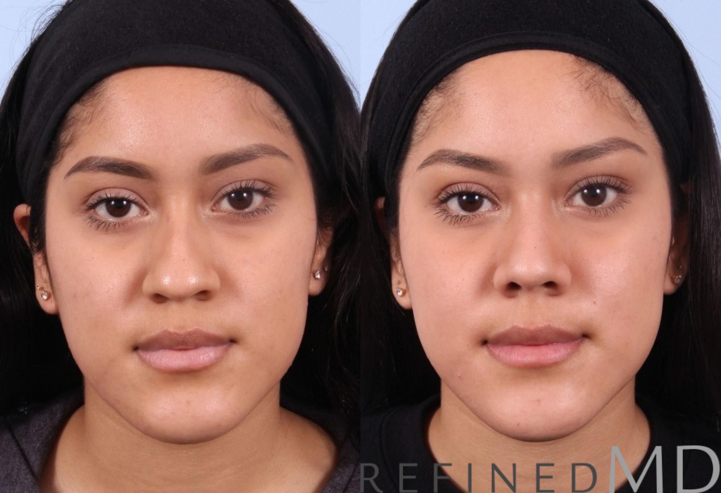 Before & After Rhinoplasty Case 1124 View 1 View in Los Gatos & San Jose, CA