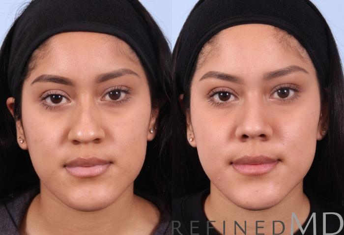 Before & After Rhinoplasty Case 1124 View 1 View in Los Gatos & San Jose, CA