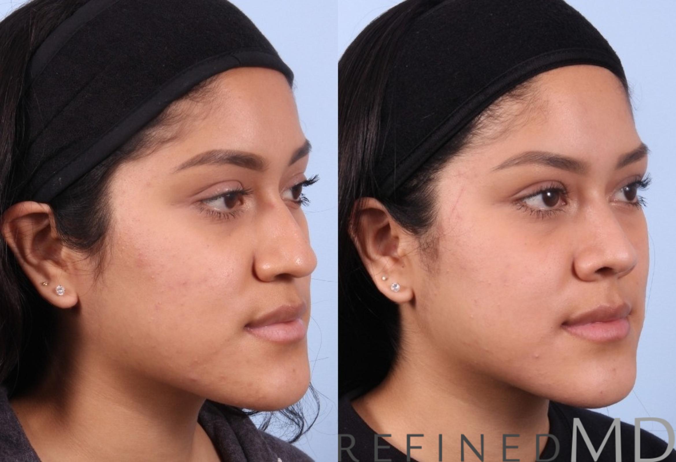 Before & After Rhinoplasty Case 1124 View 2 View in Los Gatos & San Jose, CA