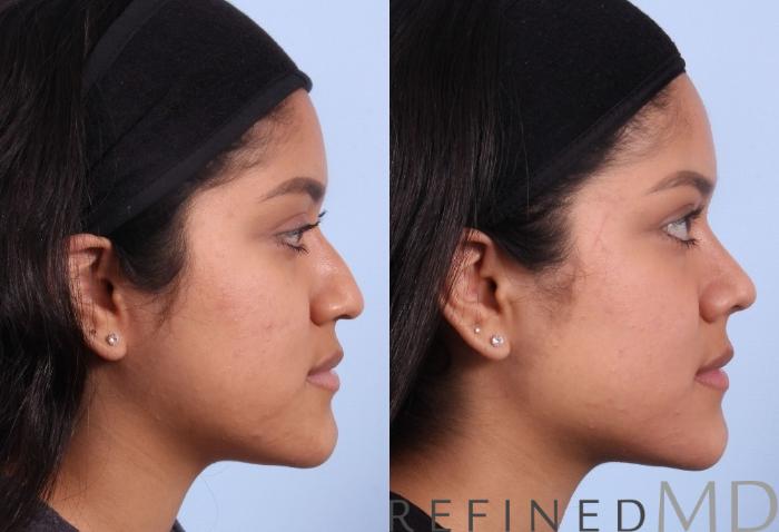 Before & After Rhinoplasty Case 1124 View 3 View in Los Gatos & San Jose, CA