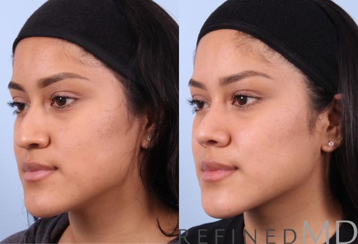 Before & After Rhinoplasty Case 1124 View 4 View in Los Gatos & San Jose, CA