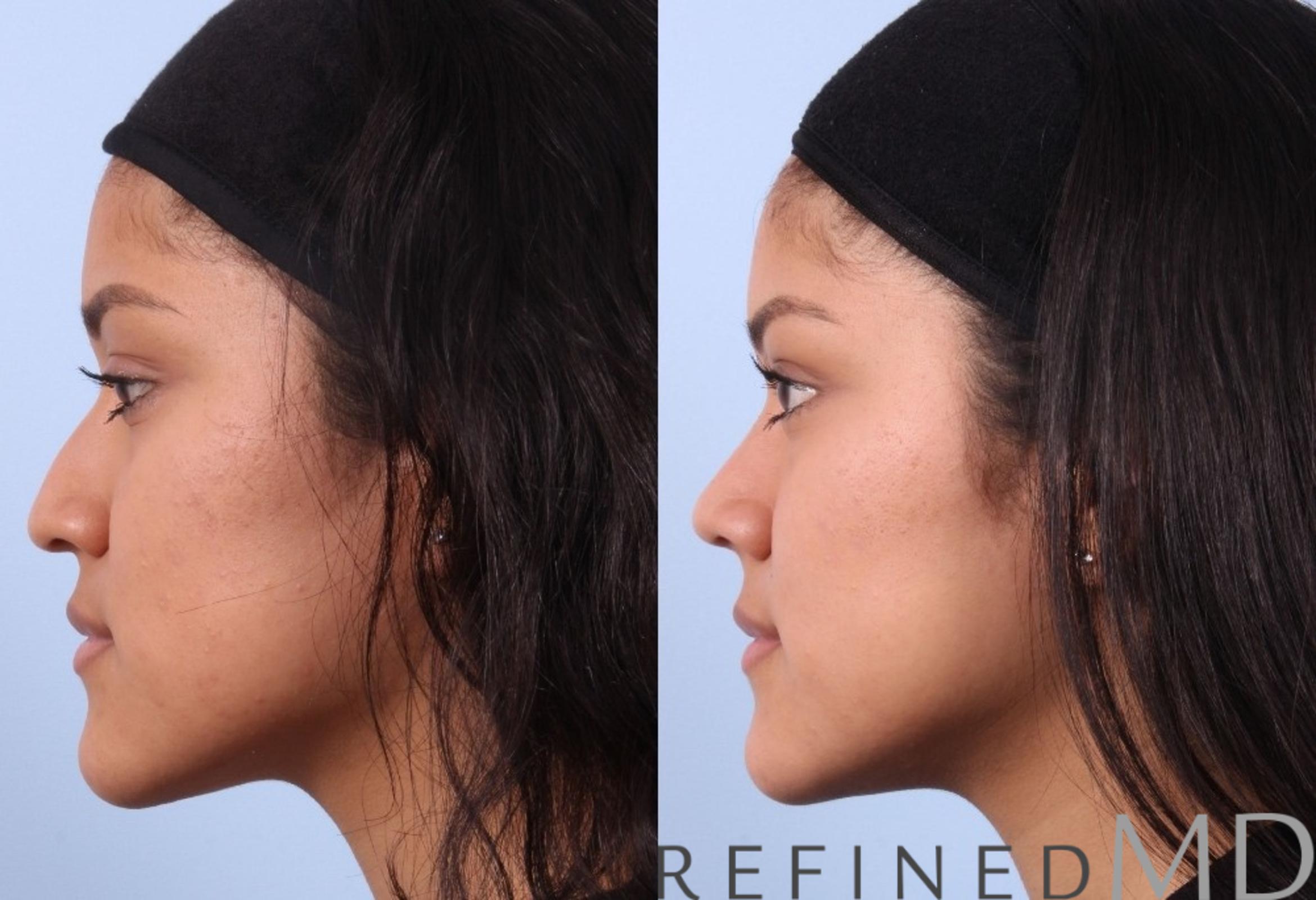 Before & After Rhinoplasty Case 1124 View 5 View in Los Gatos & San Jose, CA