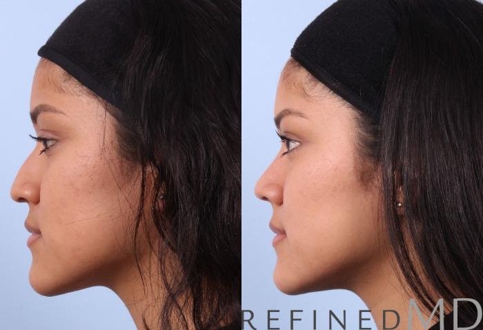 Before & After Rhinoplasty Case 1124 View 5 View in Los Gatos & San Jose, CA