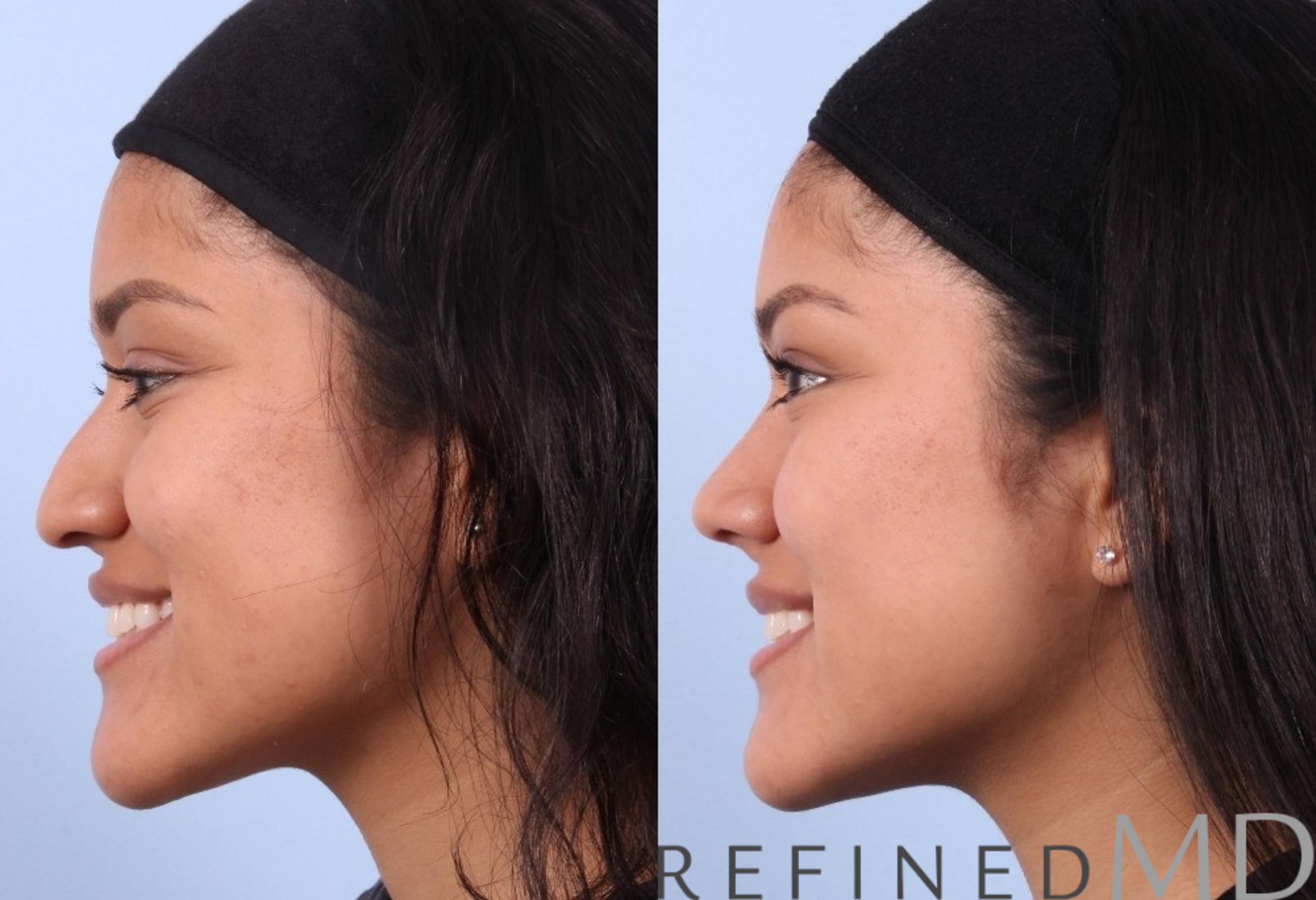 Before & After Rhinoplasty Case 1124 View 6 View in Los Gatos & San Jose, CA